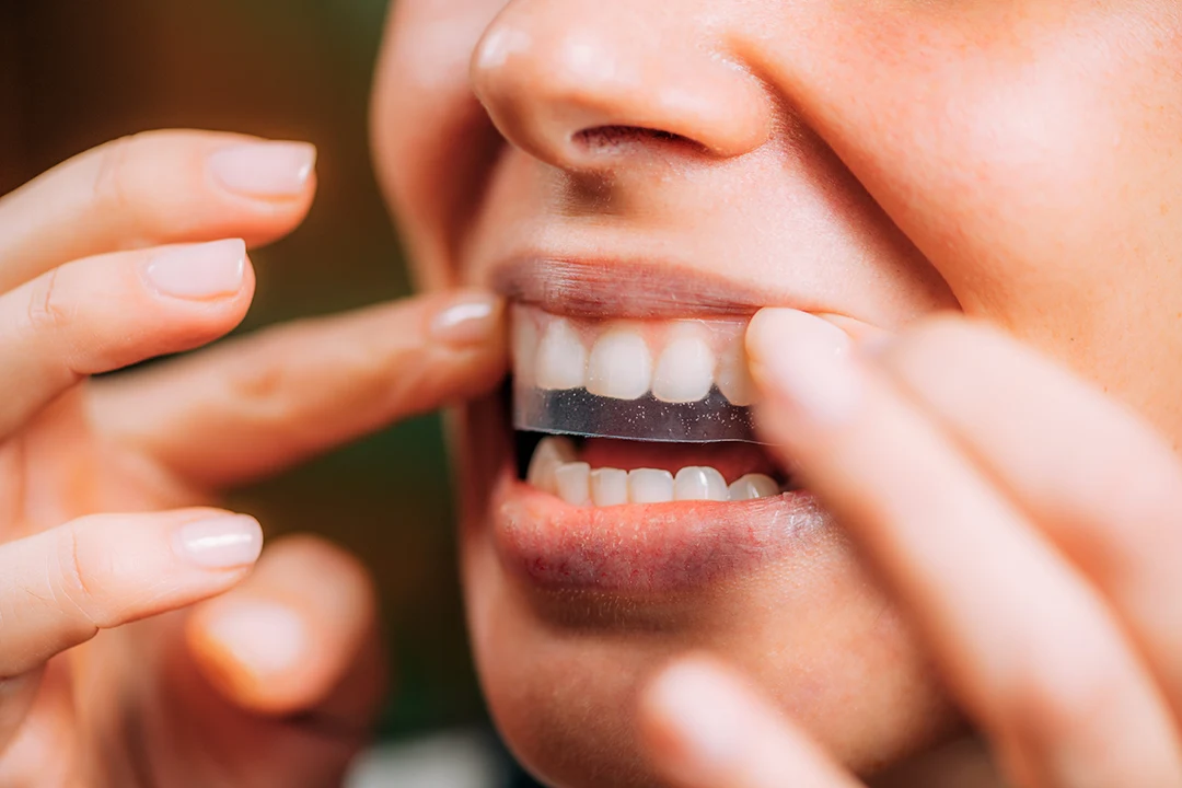 Sbiancamento dentale