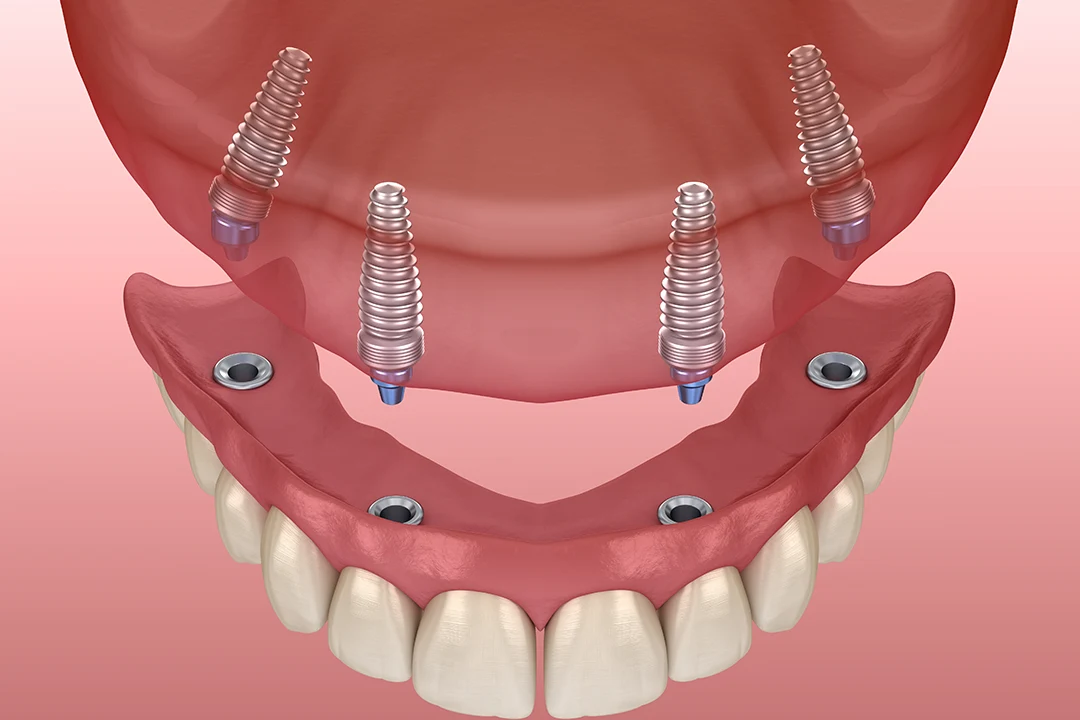 Intera arcata denti fissi