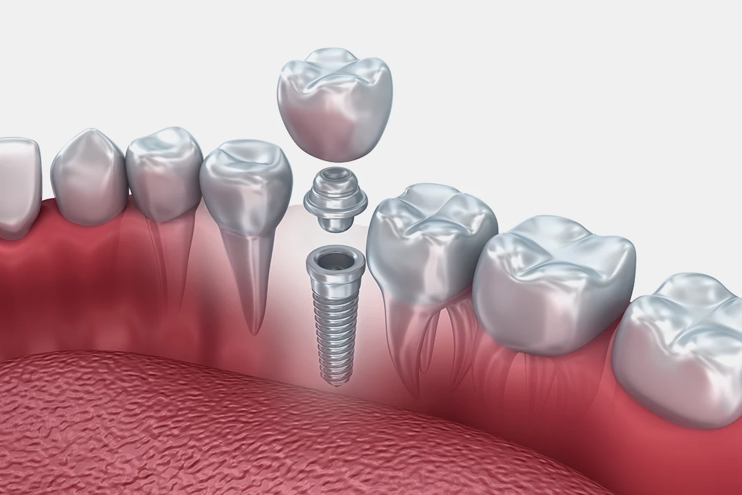 Implantologia denti fissi singolo impianto