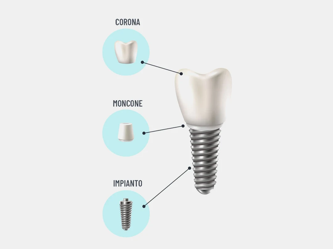 Com'è fatto un impianto dentale