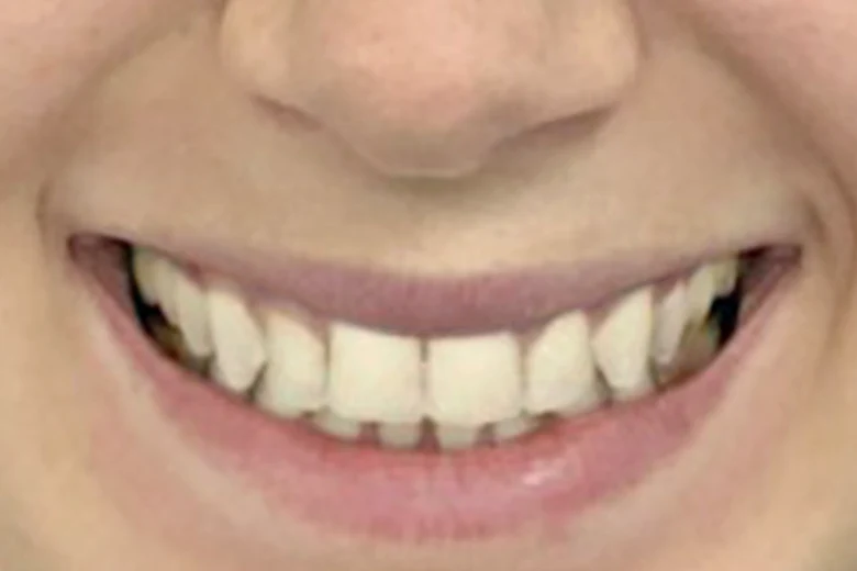 Dopo correzione disallinemanto denti