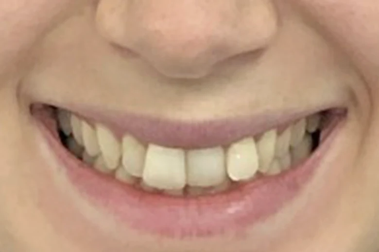Prima correzione disallinemanto denti