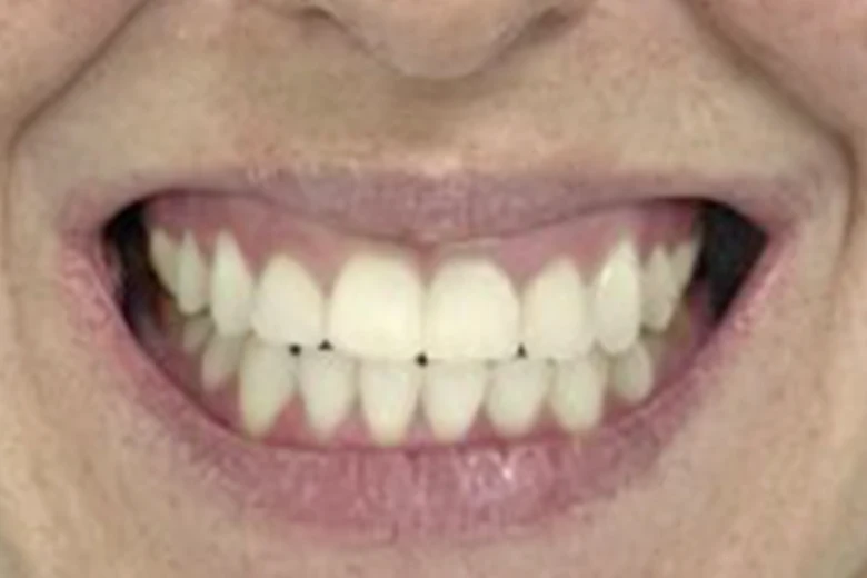 Dopo correzione disallinemanto denti