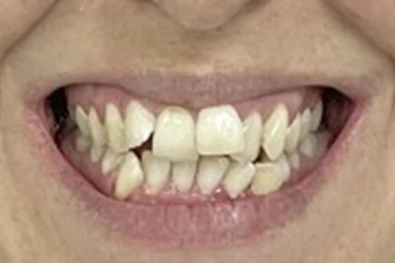Prima correzione disallinemanto denti