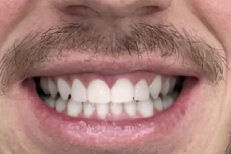 Dopo correzione diastema denti