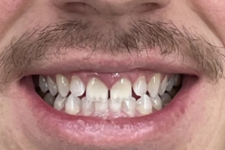 Prima correzione diastema denti