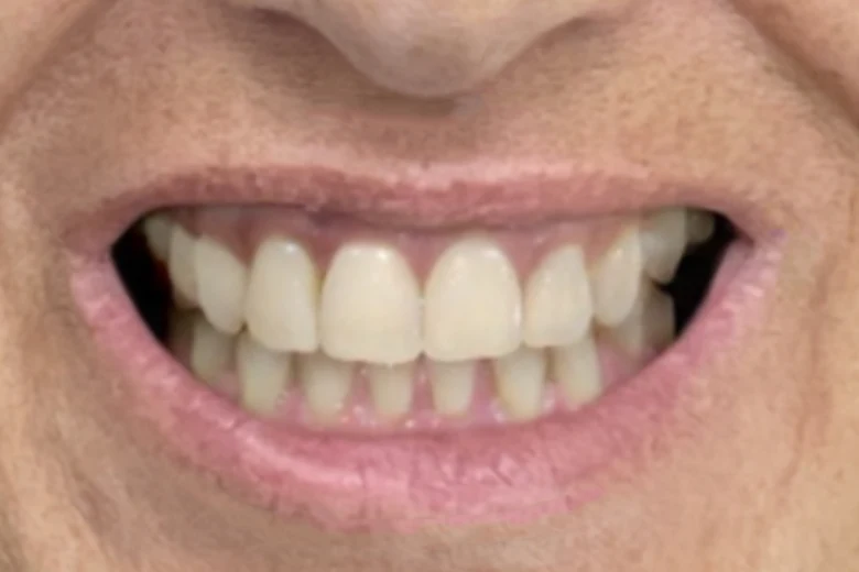 Dopo correzione diastema denti