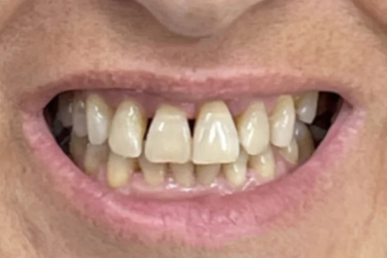 Prima correzione diastema denti
