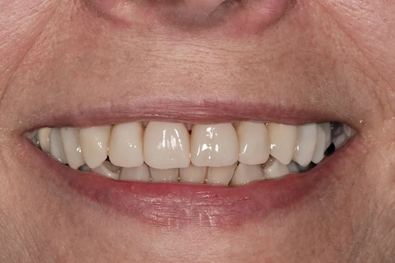Dopo correzione disallinemanto denti