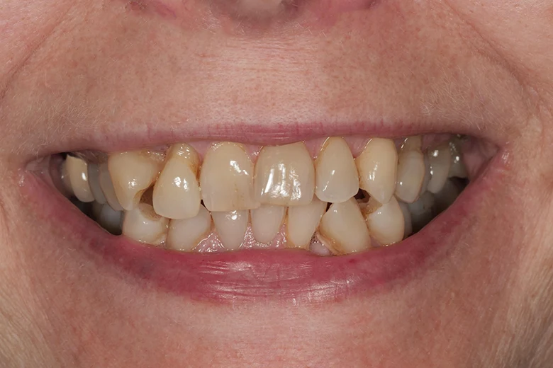 Prima correzione disallinemanto denti