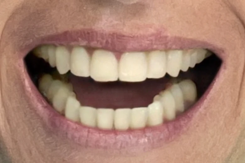 Dopo correzione disallinemanto denti