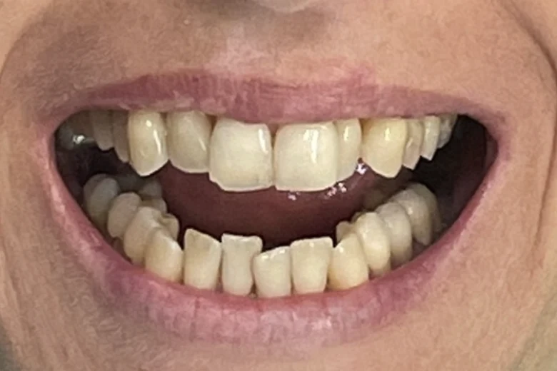 Prima correzione disallinemanto denti