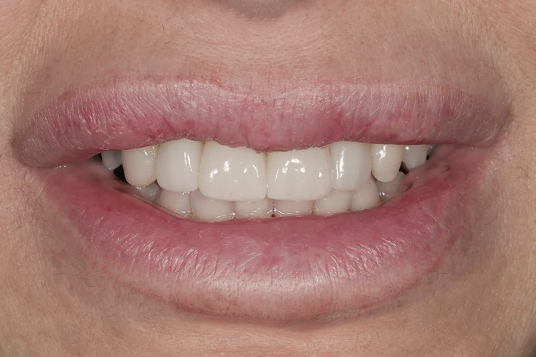 Dopo sbiancamento denti