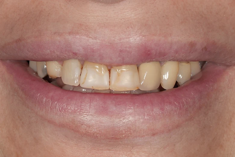Prima sbiancamento denti