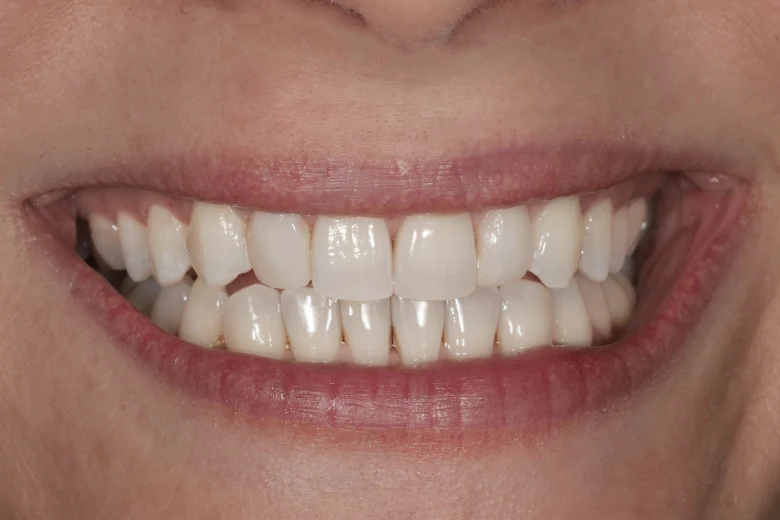 Dopo correzione diastema denti