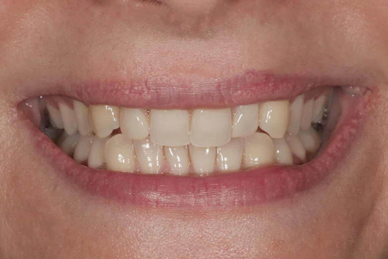 Prima correzione diastema denti