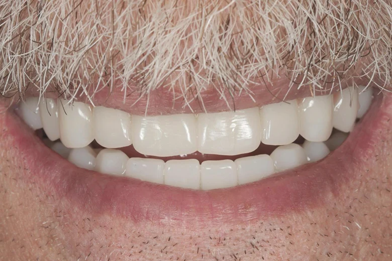 Dopo sbiancamento denti