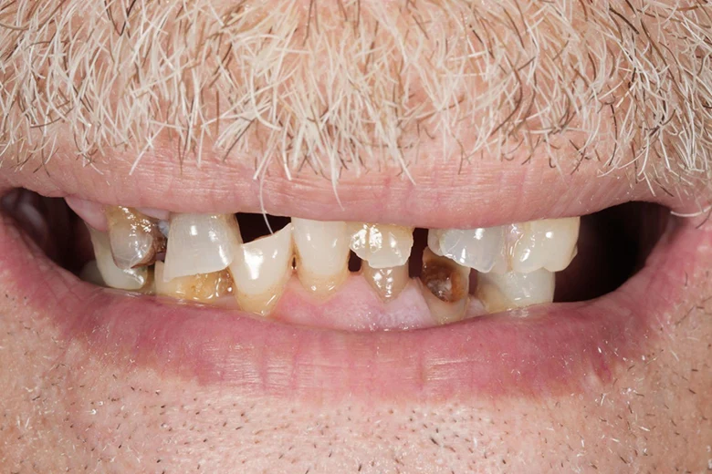 Prima sbiancamento denti